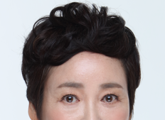 A Dramatic Transformation for Brighter, Clearer Eyes: A 5-Year Follow-Up Review of Forehead Lift Surgery in Your 60s image 5