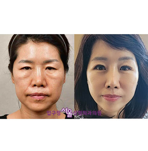 [압구정서울성형외과] 50대 이마거상, 안면거상, 하안검 후기 관련 이미지 7