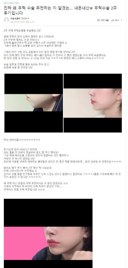 [윤곽성형] 무턱탈출, 이제 압구정서울성형외과에서! 관련 이미지 7