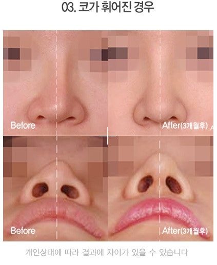 Apgujeong Seoul Plastic Surgery: Revision Rhinoplasty Methods by Type and Reviews image 6