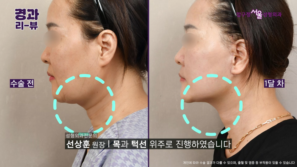 50대 안면거상 후기 팔자주름부터 목주름까지 어떻게 달라질까? 관련 이미지 7