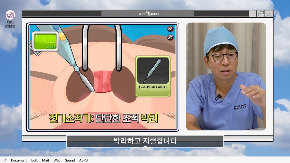 매부리코 코수술 게임 후기 및 비중격연골 매부리 코수술 방법 코수술 진행 과정 압구정서울성형외과 관련 이미지 10