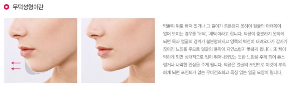 [윤곽성형] 무턱탈출, 이제 압구정서울성형외과에서! 관련 이미지 1