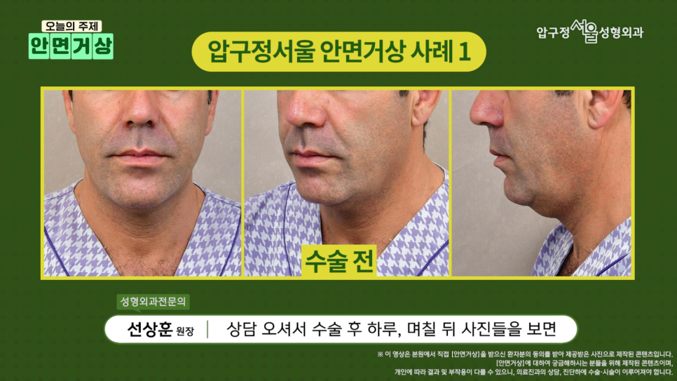 Brad Pitt Facelift?! The Secret to Looking Younger: Youthful Plastic Surgery Facelift, Apgujeong Seoul Plastic Surgery image 7