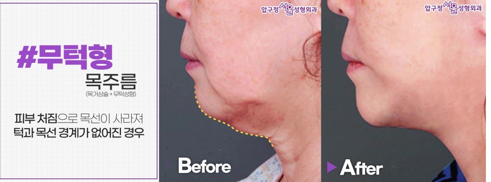 [목거상술 - 압구정 동안성형] 나의 목주름 유형은? 관련 이미지 2