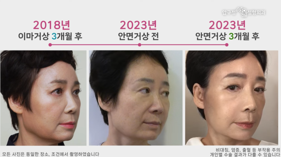 [다시, 청춘 프로젝트]60대 안면거상, 목거상 3개월 경과 후기 관련 이미지 2
