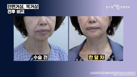 Before-and-After of Facelift and Neck Lift Surgery in Apgujeong: SMAS Facelift Case at Apgujeong Seoul Plastic Surgery image 6