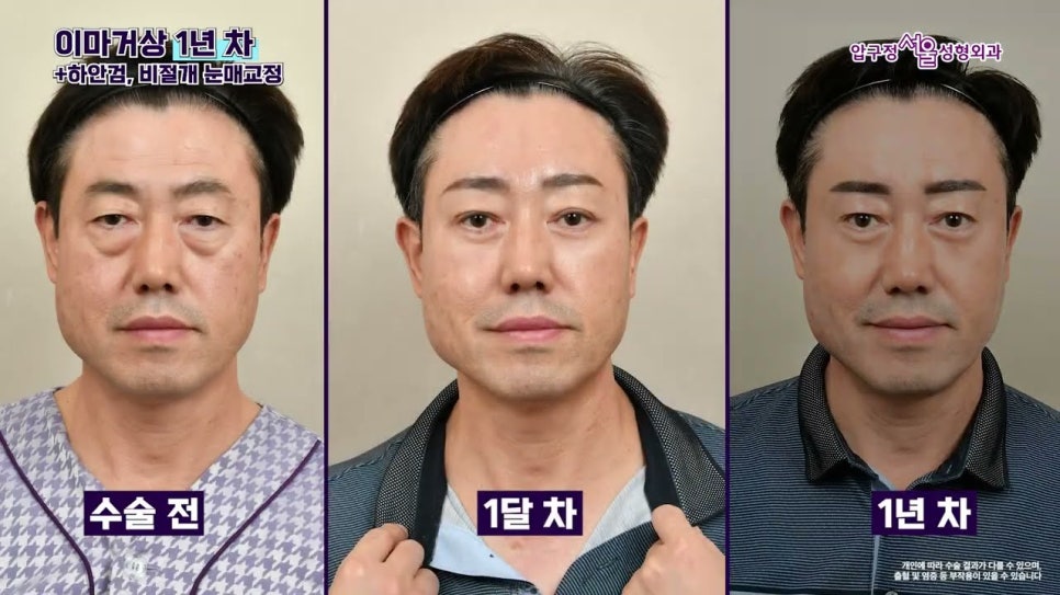 남자 이마거상 1년 후 실제 후기와 수술 전 알아야 할 핵심 포인트 관련 이미지 1