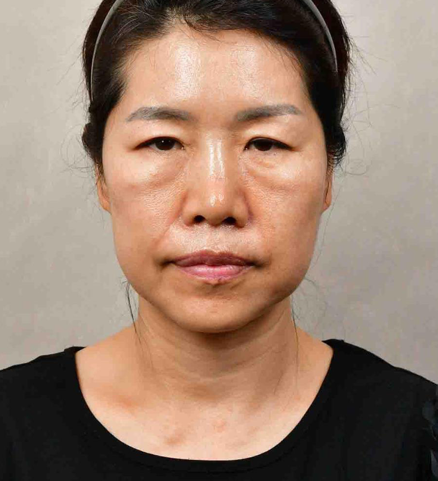 [압구정서울성형외과] 50대 이마거상, 안면거상, 하안검 후기 관련 이미지 1