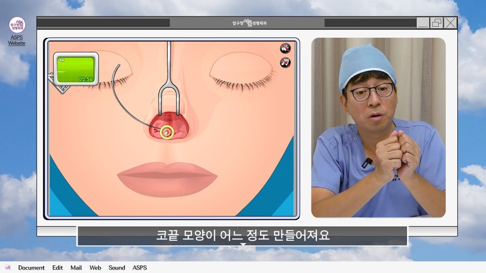 매부리코 코수술 게임 후기 및 비중격연골 매부리 코수술 방법 코수술 진행 과정 압구정서울성형외과 관련 이미지 19
