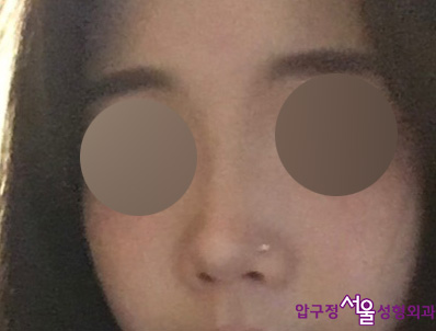 압구정서울성형외과 수험생 낮은코, 복코성형 후기 관련 이미지 1