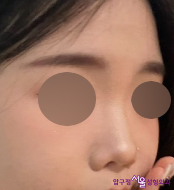 압구정서울성형외과 수험생 낮은코, 복코성형 후기 관련 이미지 2