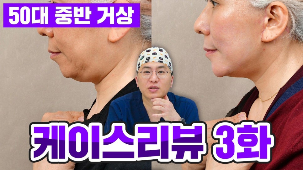 안면거상 전후 후기 압구정서울성형외과 실제 케이스 비교 분석 관련 이미지 1