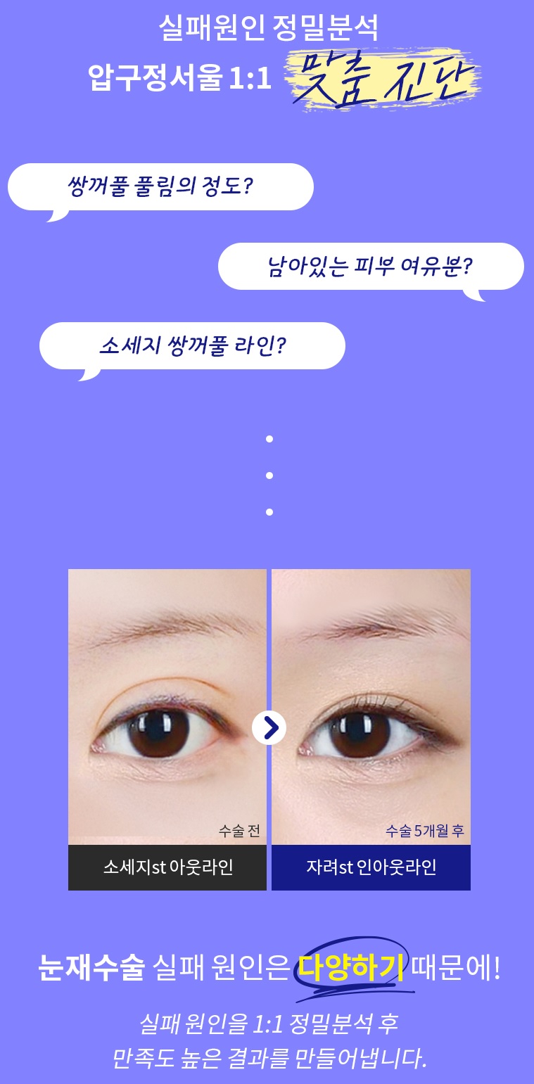 Apgujeong Seoul Plastic Surgery: Revision Eyelid Surgery Methods and Reviews by Type image 8