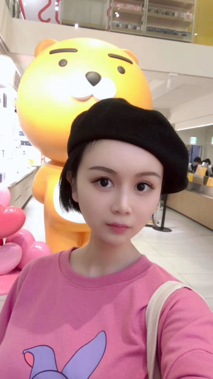 Natural-looking Double Eyelid Surgery at Apgujeong Seoul Plastic Surgery image 4