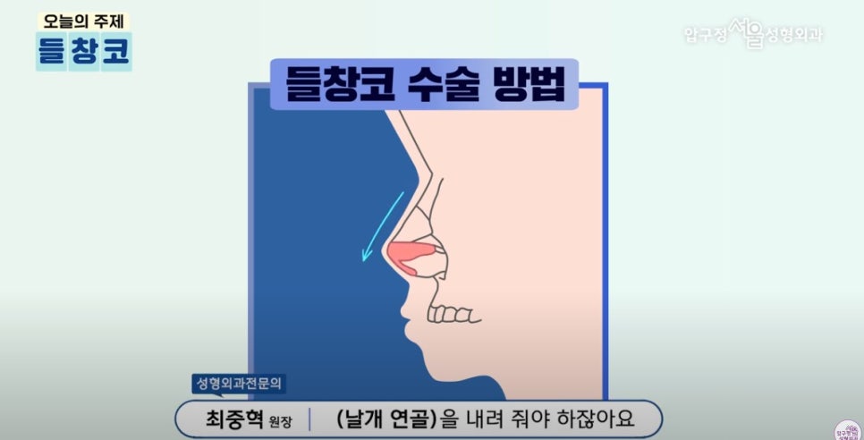 Apgujeong Plastic Surgery Nose Revision: Upturned Nose Causes and Surgery Review image 3