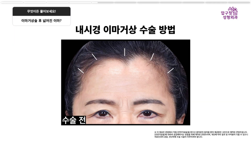 이마거상 유지기간 회복기간, 수술 전 알아야 할 핵심 Q&A 관련 이미지 8