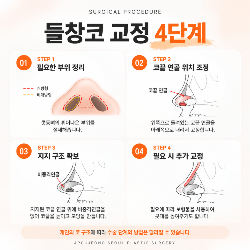 들창코 성형 압구정서울성형외과 "정면에서 콧구멍이 보인다면?" 관련 이미지 4