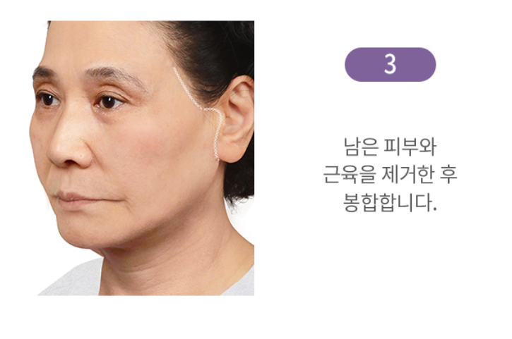 "SMAS Facelift" to Firmly Restore Sagging Jowls and Nasolabial Folds image 13