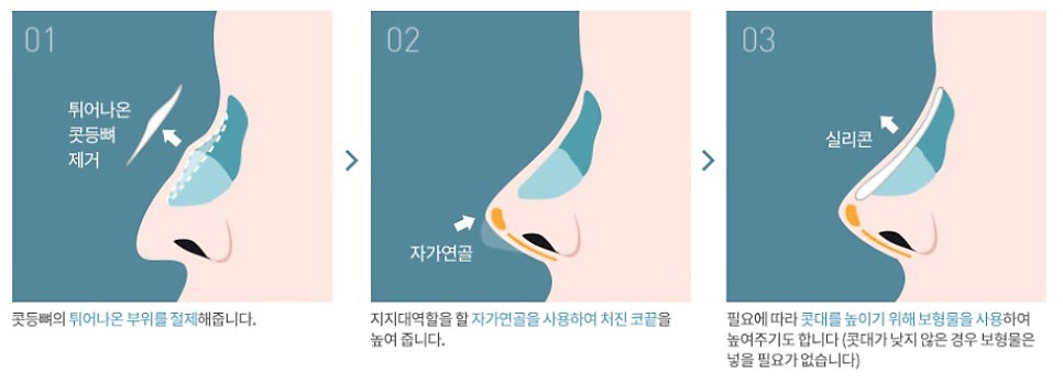 매부리코 뜻, 압구정서울성형외과 남자, 여자 매부리코 교정 성형수술 방법 (매부리코 연예인) 관련 이미지 8