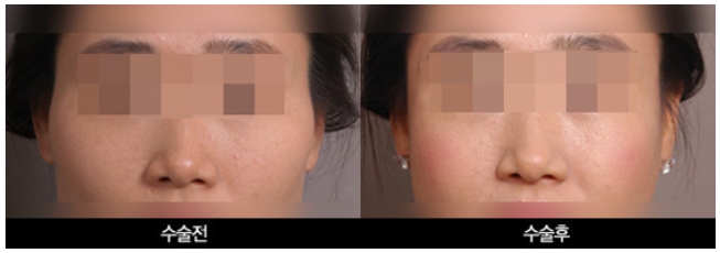 Types of Zygoma Reduction Surgery, Contour Surgery That Can Correct a Peanut-Shaped Face | Apgujeong Seoul Plastic Surgery image 7