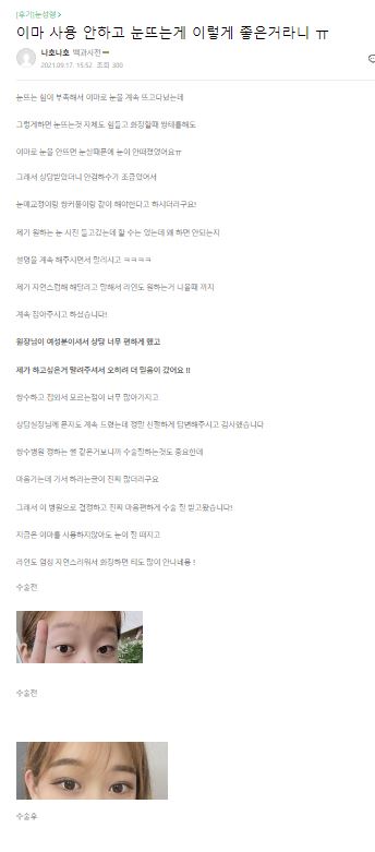 Lovely Eyes Are No Longer Difficult! [Apgujeong Seoul Plastic Surgery] image 8