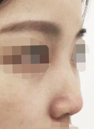 IU’s Small Nose and Low Nasal Bridge Surgery at Apgujeong Seoul Plastic Surgery image 5