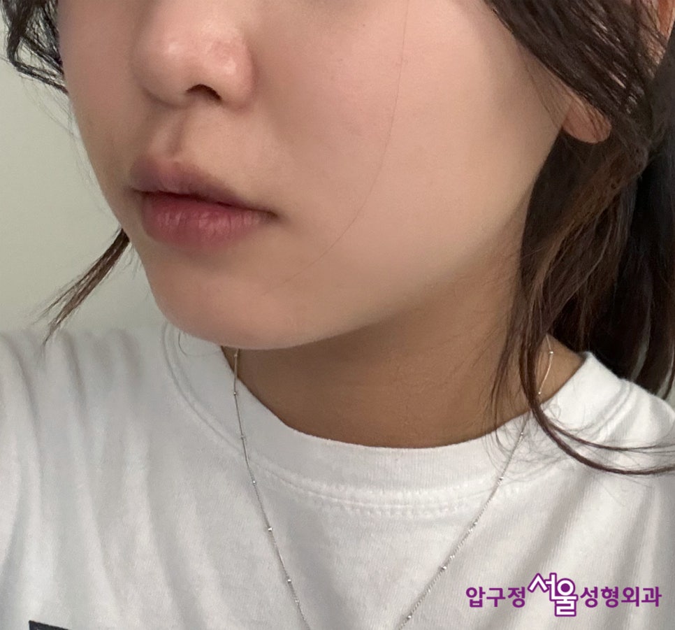 Chin Implant Surgery, a More Definitive Effect Than Fillers image 4