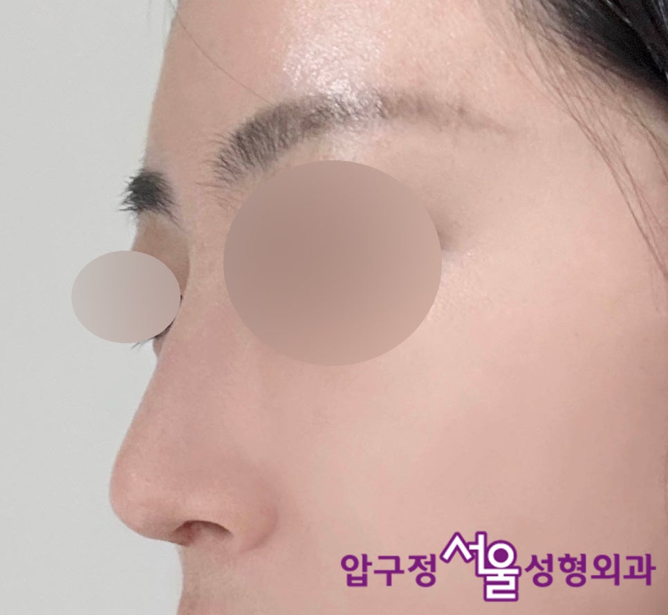 압구정 무보형물 코수술로 효과보는 매부리코 유형 관련 이미지 4