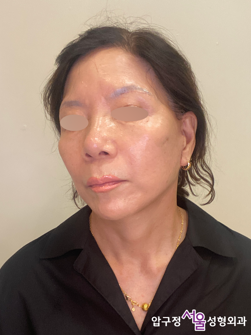 Curious About Reviews of a Clinic That Does Facelift Surgery Well at Apgujeong Seoul Plastic Surgery? image 7