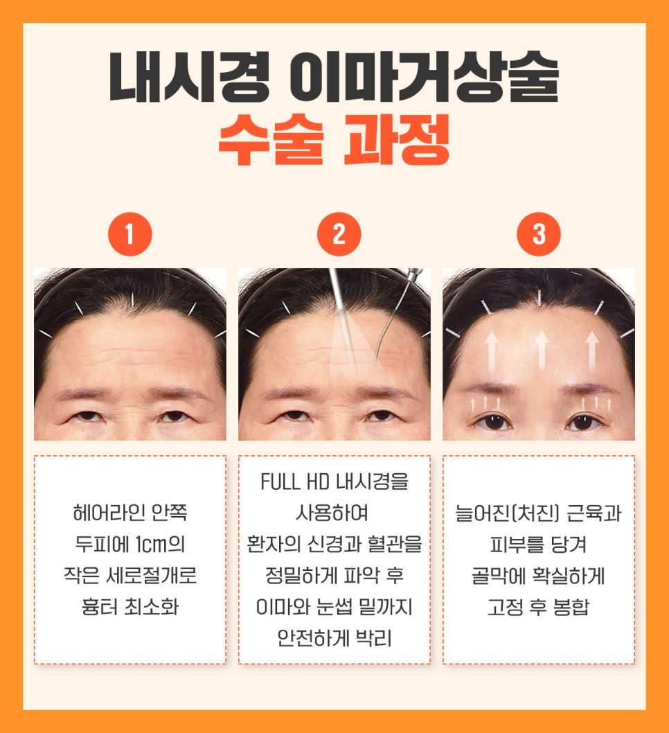 압구정 이마거상 여자 이마거상 효과 내시경이마거상술 전후 사례 이마주름 원인 관련 이미지 3