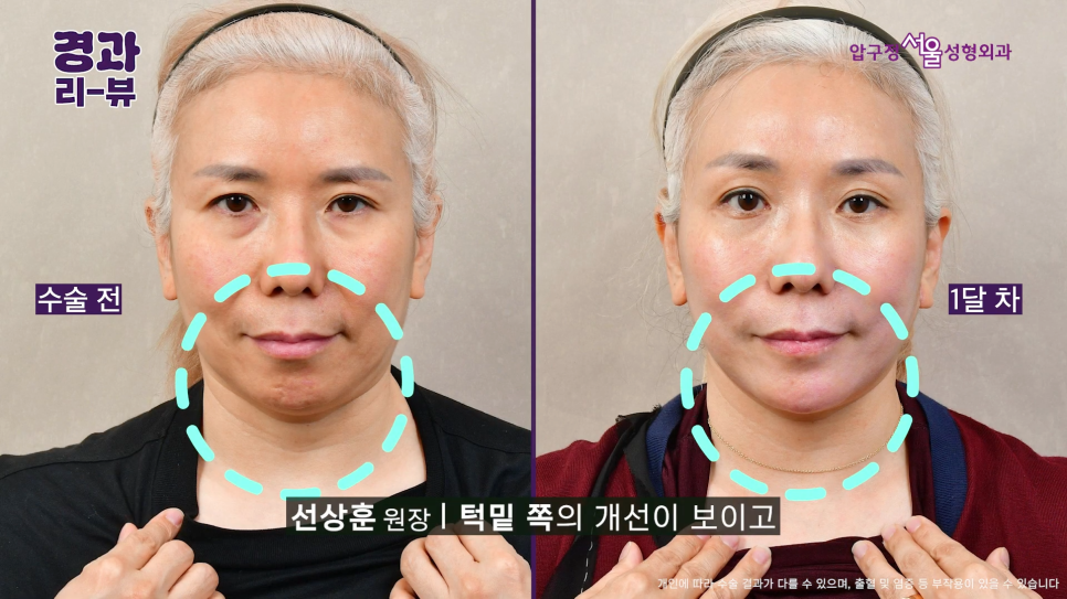 안면거상 전후 후기 압구정서울성형외과 실제 케이스 비교 분석 관련 이미지 5
