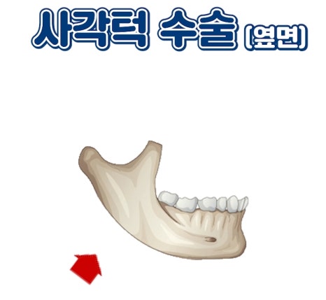 압구정 안면윤곽 사각턱, 광대, 턱끝 개념과 종류 수술방법 압구정서울성형외과 관련 이미지 16