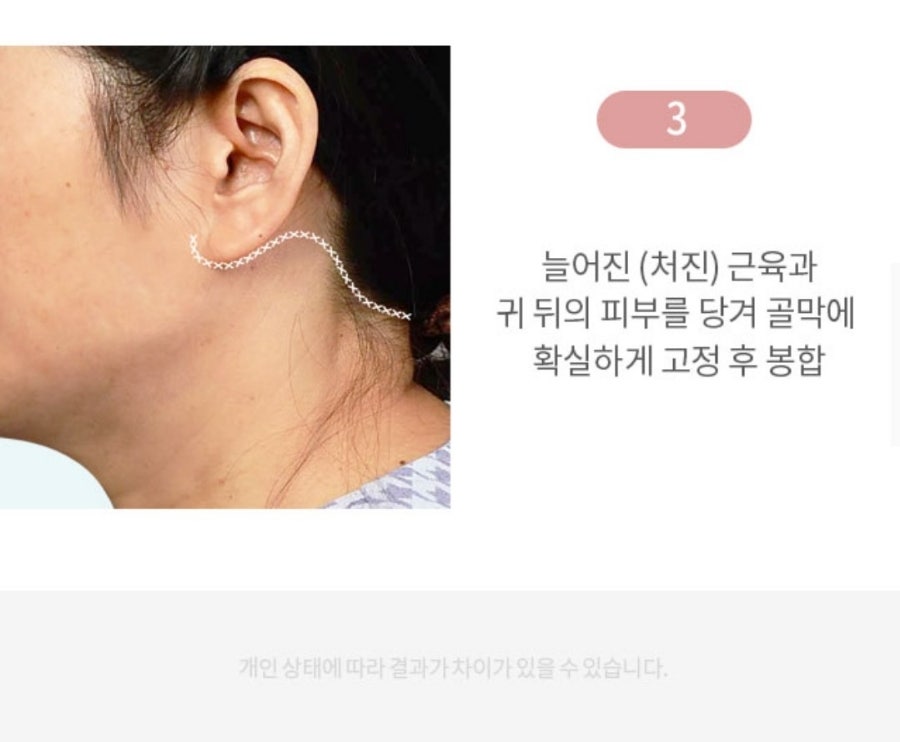 나이테같은 목주름을 확실히 당겨주는 방법은? "목거상술" 관련 이미지 7