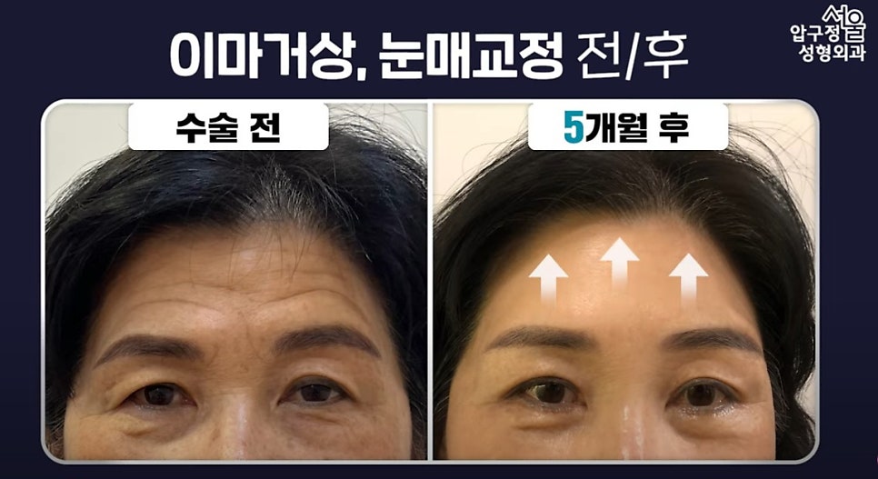 압구정서울성형 이마거상술로 이마주름 고민해결 후기 관련 이미지 5