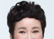 A Dramatic Transformation for Brighter, Clearer Eyes: A 5-Year Follow-Up Review of Forehead Lift Surgery in Your 60s image 6
