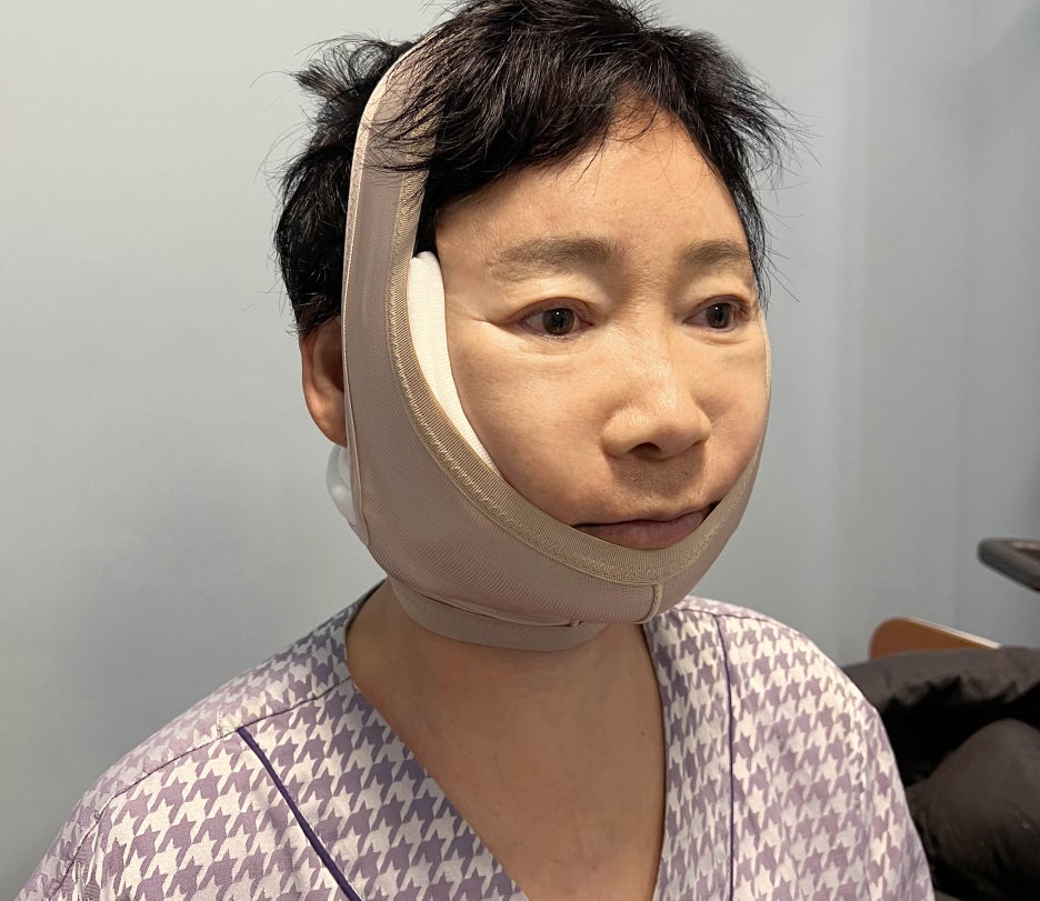 [다시, 청춘 프로젝트] 60대 안면거상, 목거상 상담 및 수술 후기 ③ 관련 이미지 4