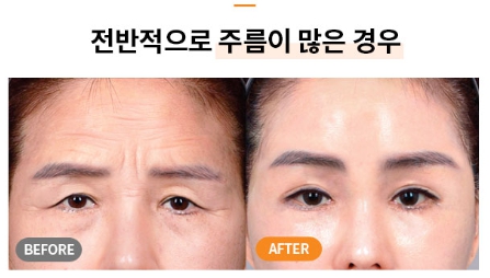 Worried About Forehead Wrinkles? A Quick Overview of Men’s Forehead Lifts and Forehead Lift Surgery Costs image 6