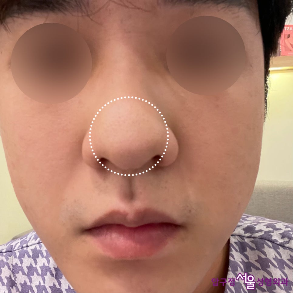 Apgujeong Seoul Plastic Surgery: Review of a Man’s Hump Nose and Bulbous Nose Surgery image 4