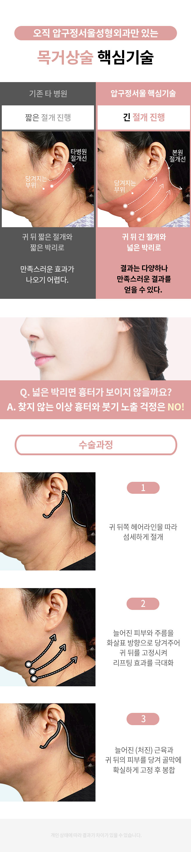 압구정성형외과 목주름 관련 이미지 3