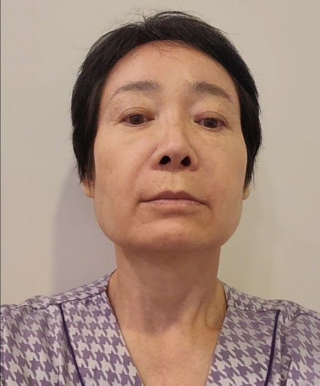 [Again, Youth Project] Consultation and Surgery Review for Facelift + Neck Lift in Your 60s ① image 9