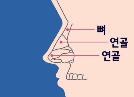들창코 구축코 짧은코 원인, 차이 코수술재료, 코성형 압구정서울성형외과 관련 이미지 7