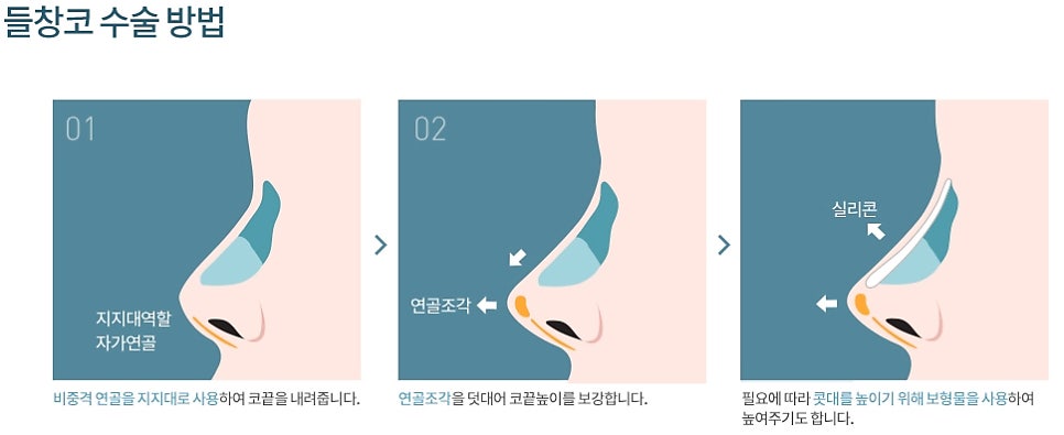 들창코 구축코 짧은코 원인, 차이 코수술재료, 코성형 압구정서울성형외과 관련 이미지 9