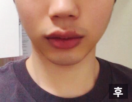 A Good Place for Chin Surgery: Apgujeong Seoul Plastic Surgery image 4