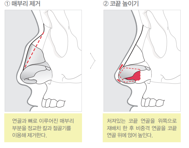 [Apgujeong Seoul Plastic Surgery] Natural Straight Line Improvement After Hump Nose Surgery! image 4