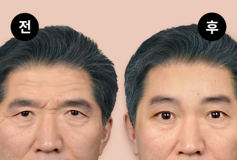 Worried About Forehead Wrinkles? A Quick Overview of Men’s Forehead Lifts and Forehead Lift Surgery Costs image 1