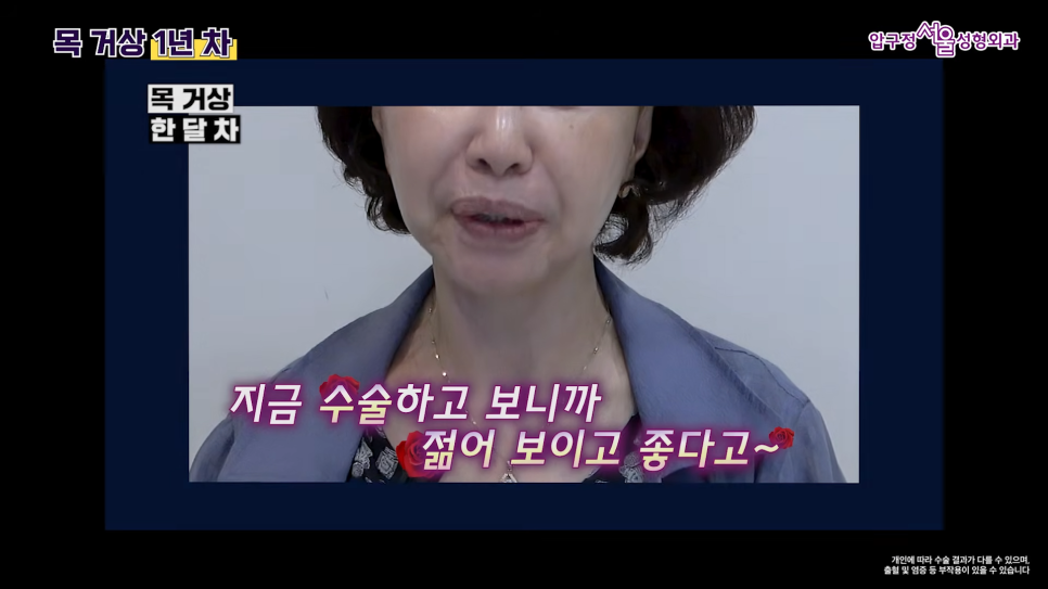 목거상 흉터 후기 목주름 수술 1년 후 변화 압구정서울성형외과 실제 사례로 알아보기 관련 이미지 5