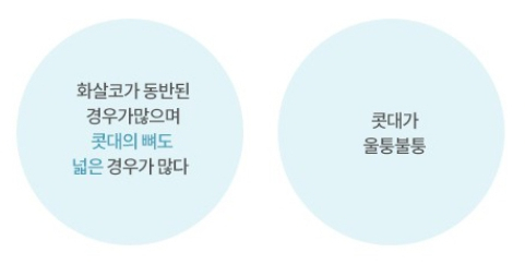 매부리코 뜻, 압구정서울성형외과 남자, 여자 매부리코 교정 성형수술 방법 (매부리코 연예인) 관련 이미지 1