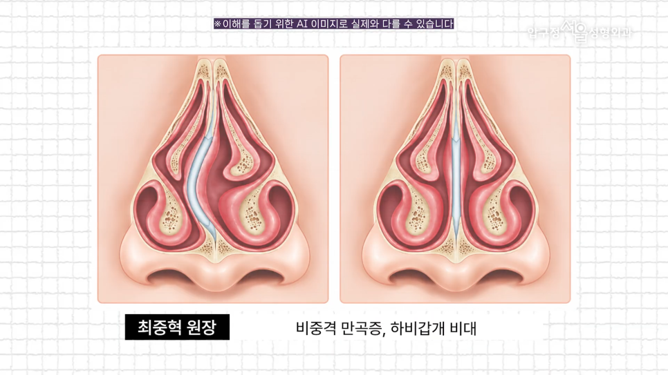 기능코수술 압구정서울성형외과 코막힘과 코 모양을 함께 고려한다면 관련 이미지 4