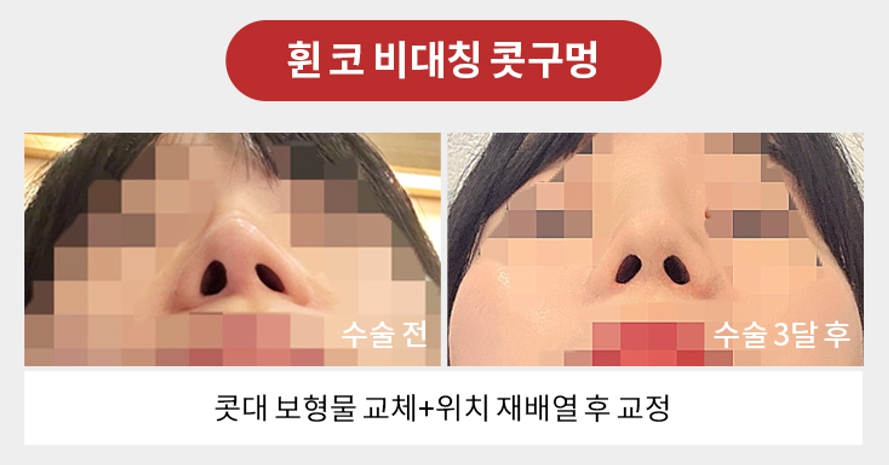 Revision Rhinoplasty Plastic Surgery: Female and Male Nose Surgery at Apgujeong Seoul Plastic Surgery image 5
